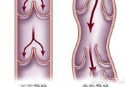 什么樣的人容易得筋脈曲張？靜脈曲張的原因
