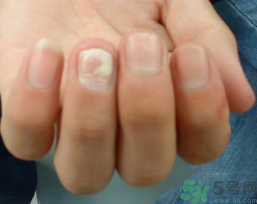 指甲發(fā)白是怎么回事？指甲發(fā)白代表什么？