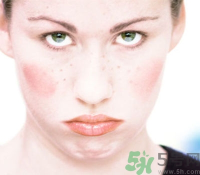 夏季流汗臉癢怎么回事？夏季臉癢怎么辦？