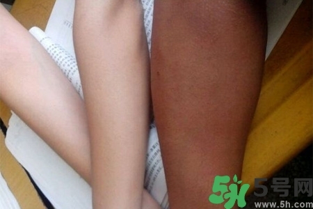 腿曬黑了怎么白回來？腿曬黑了怎么辦？