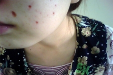 激光點(diǎn)痣后可以洗臉嗎？激光點(diǎn)痣后需要注意什么？