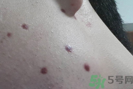 激光點(diǎn)痣后可以洗臉嗎？激光點(diǎn)痣后需要注意什么？