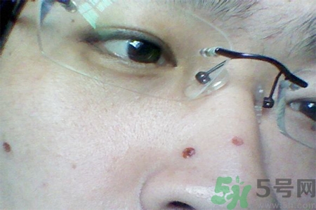 激光點(diǎn)痣后可以洗臉嗎？激光點(diǎn)痣后需要注意什么？