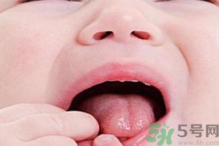 寶寶口腔潰瘍怎么辦？治療寶寶口腔潰瘍方法有什么？