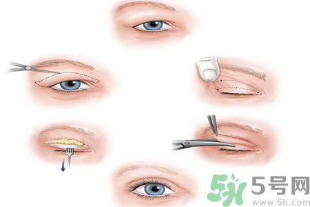 割雙眼皮分哪幾種？割雙眼皮需要多少錢？