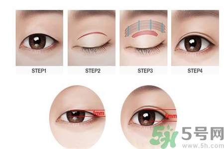 割雙眼皮分哪幾種？割雙眼皮需要多少錢？