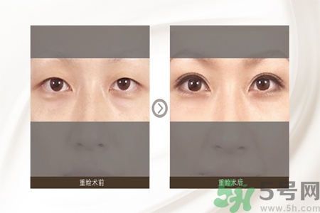 割雙眼皮分哪幾種？割雙眼皮需要多少錢？