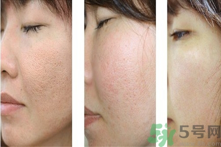 皮膚毛孔粗大原因有哪些？如何預(yù)防皮膚毛孔粗大？