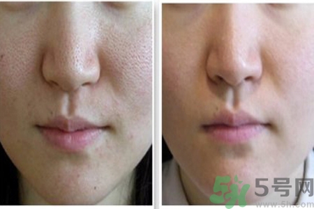 皮膚毛孔粗大原因有哪些？如何預(yù)防皮膚毛孔粗大？