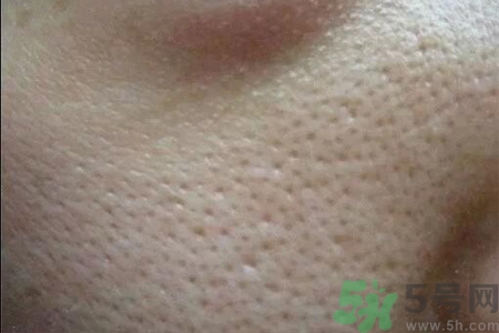 皮膚毛孔粗大原因有哪些？如何預(yù)防皮膚毛孔粗大？
