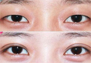 割雙眼皮分哪幾種？割雙眼皮需要多少錢？