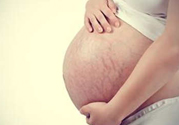 什么是妊娠紋？妊娠紋什么時(shí)候開始長？