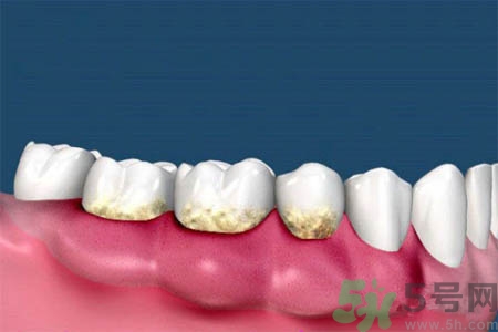 哪些人不能洗牙？洗牙需要注意什么？