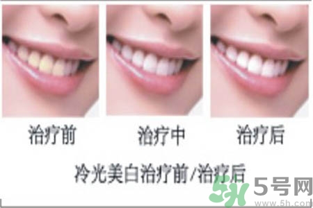 冷光美白牙齒是什么？冷光美白牙齒的好處有哪些？