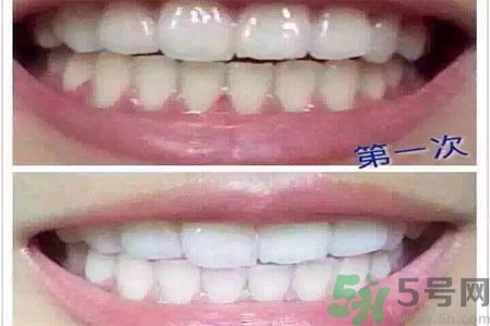 冷光美白牙齒的價格是多少？做冷光美白牙齒需要多少錢？