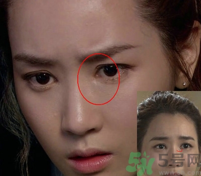 開(kāi)眼角多少錢(qián)？開(kāi)眼角有什么危害？