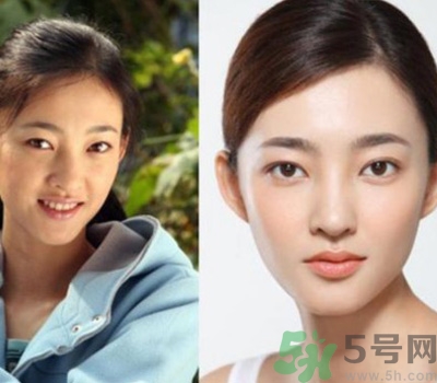 開眼角眼睛會變大嗎？開眼角眼睛能大多少？