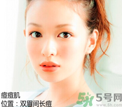 眉心長痘痘是什么原因？眉心長痘痘怎么辦？