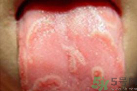 舌頭燙傷后該怎么辦呢？舌頭燙傷后應(yīng)該注意吃什么？?