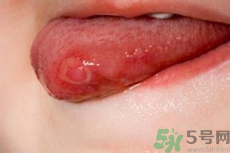 舌頭長泡怎么辦？舌頭長泡的原因？