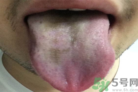 舌頭發(fā)黑怎么回事？舌頭發(fā)黑怎么辦？