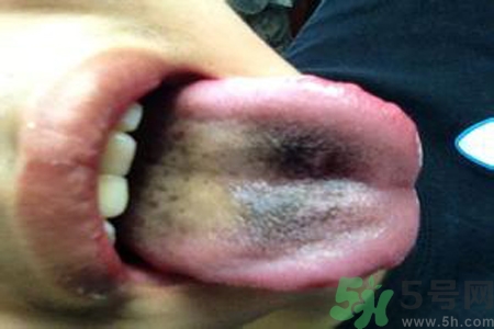 舌頭發(fā)黑怎么回事？舌頭發(fā)黑怎么辦？