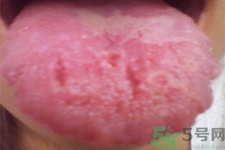 舌頭上有裂紋是怎么辦？舌頭上有裂紋是什么原因？