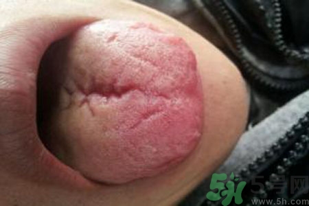 舌頭上有裂紋是怎么辦？舌頭上有裂紋是什么原因？