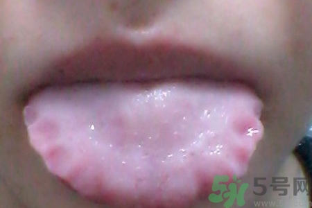 舌頭上有齒痕怎么回事？舌頭上有齒痕怎么辦？