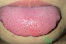 舌頭上有齒痕怎么回事？舌頭上有齒痕怎么辦？