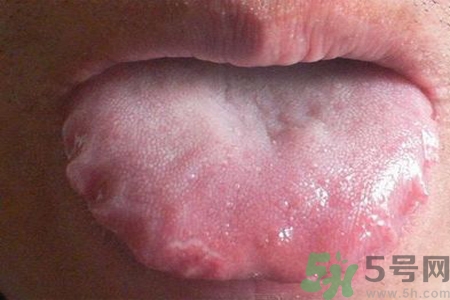 舌頭上有齒痕怎么回事？舌頭上有齒痕怎么辦？