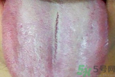 舌頭發(fā)白是什么原因？舌苔發(fā)白是怎么辦？