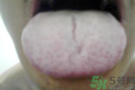 舌頭發(fā)白是什么原因？舌苔發(fā)白是怎么辦？