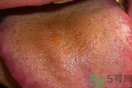 舌苔厚黃是怎么回事？舌頭發(fā)黃怎么辦？