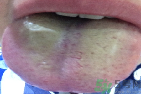 舌苔厚黃是怎么回事？舌頭發(fā)黃怎么辦？