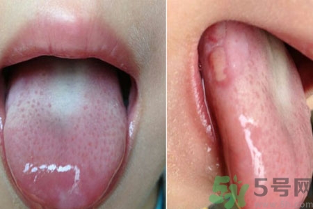 舌頭潰瘍怎么辦？舌頭潰瘍的原因？