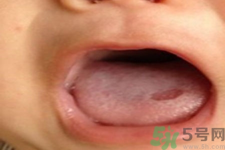 舌頭潰瘍怎么辦？舌頭潰瘍的原因？