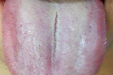 舌頭發(fā)白是什么原因？舌苔發(fā)白是怎么辦？