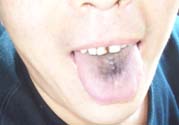 舌頭發(fā)黑怎么回事？舌頭發(fā)黑怎么辦？