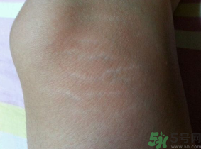 肥胖紋能去掉嗎？ 肥胖紋瘦了以后會消失嗎？