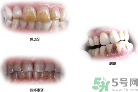 四環(huán)素牙是什么？四環(huán)素牙是怎么形成的？