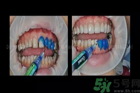 四環(huán)素牙是什么？四環(huán)素牙是怎么形成的？