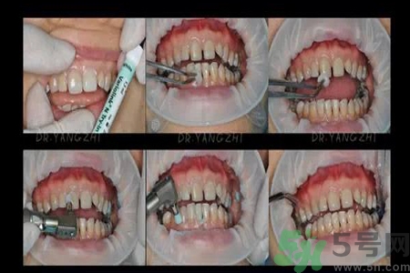 四環(huán)素牙是什么？四環(huán)素牙是怎么形成的？