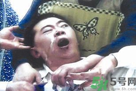 癲癇的典型癥狀有哪些？癲癇是什么？