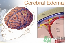 癲癇的發(fā)病因素？癲癇的并發(fā)癥有哪些？