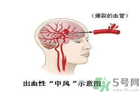 腦中風(fēng)的護(hù)理措施？腦中風(fēng)的飲食護(hù)理？