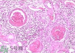 慢性腎炎能治好嗎？慢性腎炎能活多久？