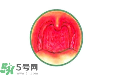 慢性咽炎的治療方法？慢性咽炎的藥物治療？