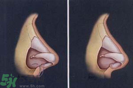 鼻竇炎的護理措施？鼻竇炎的飲食護理？