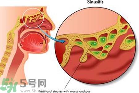 鼻竇炎的護理措施？鼻竇炎的飲食護理？